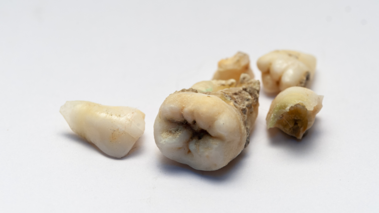 5 Hidden Habits That Are Secretly Ruining Your Enamel