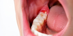 Wisdom Tooth Pain: When Should You Remove It?