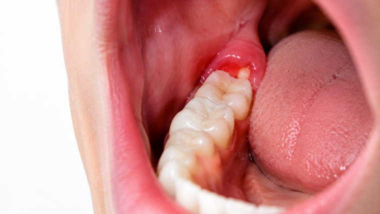 Wisdom Tooth Pain: When Should You Remove It?