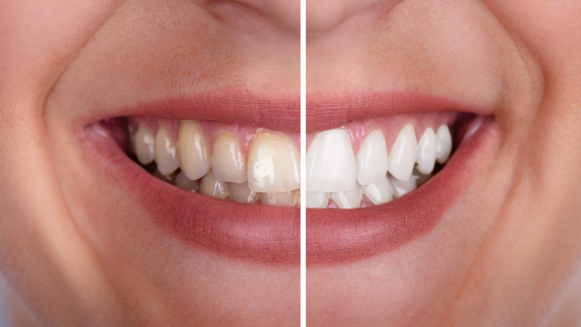 Professional Whitening vs. At-Home Kits: What Actually Works?