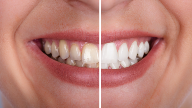 Professional Whitening vs. At-Home Kits: What Actually Works?