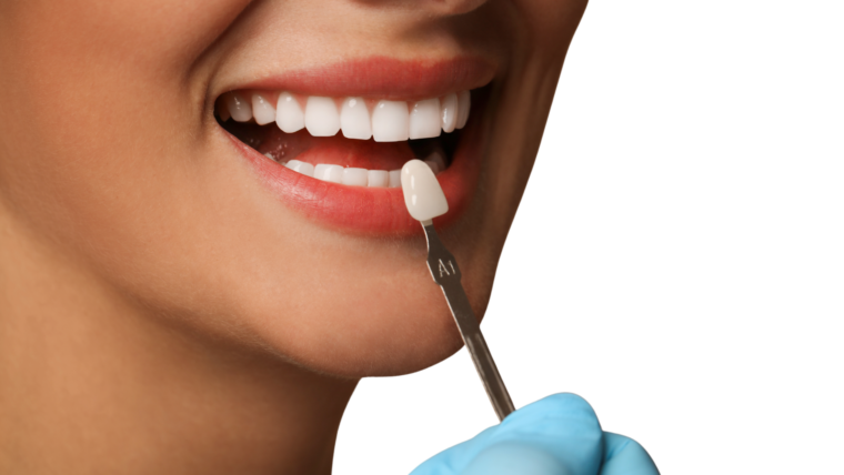 Are Veneers Right for You? Everything You Need to Know