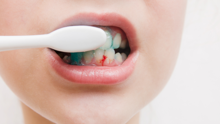 Why Do My Gums Bleed? Common Causes and Fixes