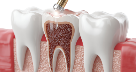 Root Canals Demystified: Why They Save Teeth, Not Hurt – 2