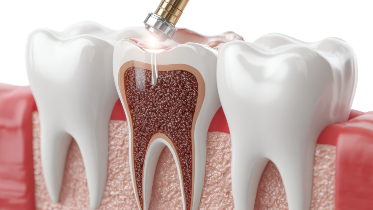 Root Canals Demystified: Why They Save Teeth, Not Hurt