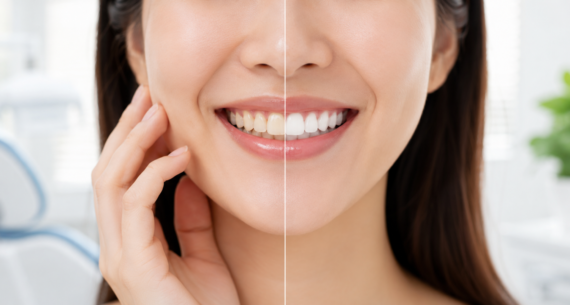 How Long Does Teeth Whitening Last? Tips to Keep Your Smile Bright