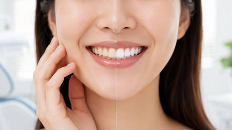 How Long Does Teeth Whitening Last? Tips to Keep Your Smile Bright
